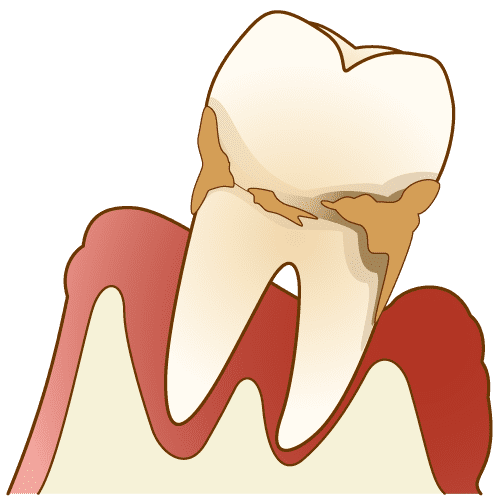 歯周病治療　歯周外科