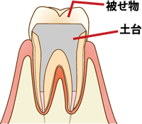 虫歯の深い歯はどうやって治療するの？ | 諫早駅前歯科