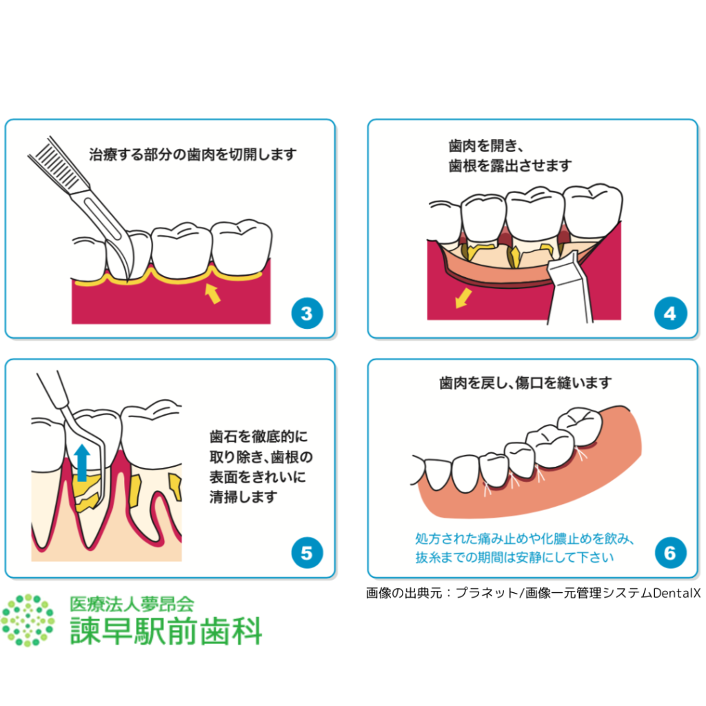 長崎県　諫早市　歯医者　諫早駅前歯科　歯周外科　フラップ手術