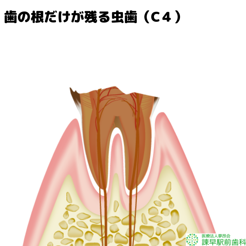 長崎　諫早　歯医者　諫早駅前　歯の構造