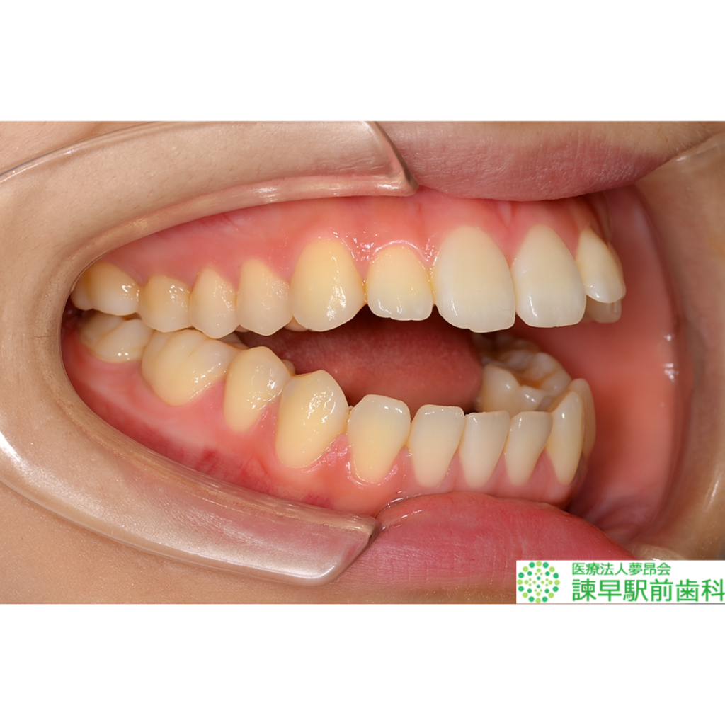 指しゃぶりによる開咬(かいこう)の症例。奥歯は噛み合っているが前歯の上下に隙間がある状態。